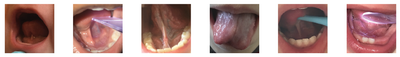 "Functional Assessment of Feeding Challenges in Children with Ankyloglossia"