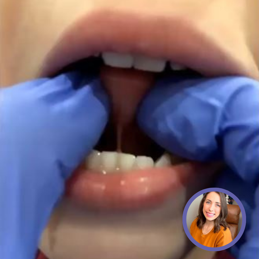 Close-up of a person’s mouth with gloved hands demonstrating a dental technique.